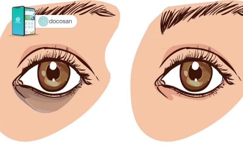 10 cách trị thâm mắt tại nhà đơn giản mà hiệu quả nhất