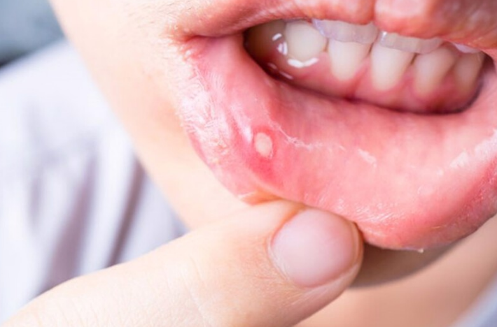 Trị nhiệt miệng bằng xát muối có thật sự hiệu nghiệm? 1