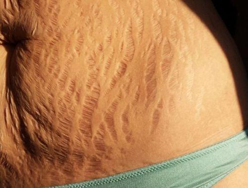 Có nên tự chườm nóng bụng sau sinh?