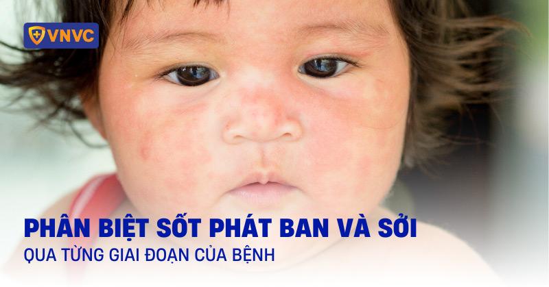 Hình ảnh sốt phát ban và sởi: Phân biệt qua từng giai đoạn của bệnh