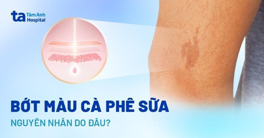 Bớt màu cà phê sữa: Nguyên nhân, dấu hiệu, chẩn đoán, điều trị