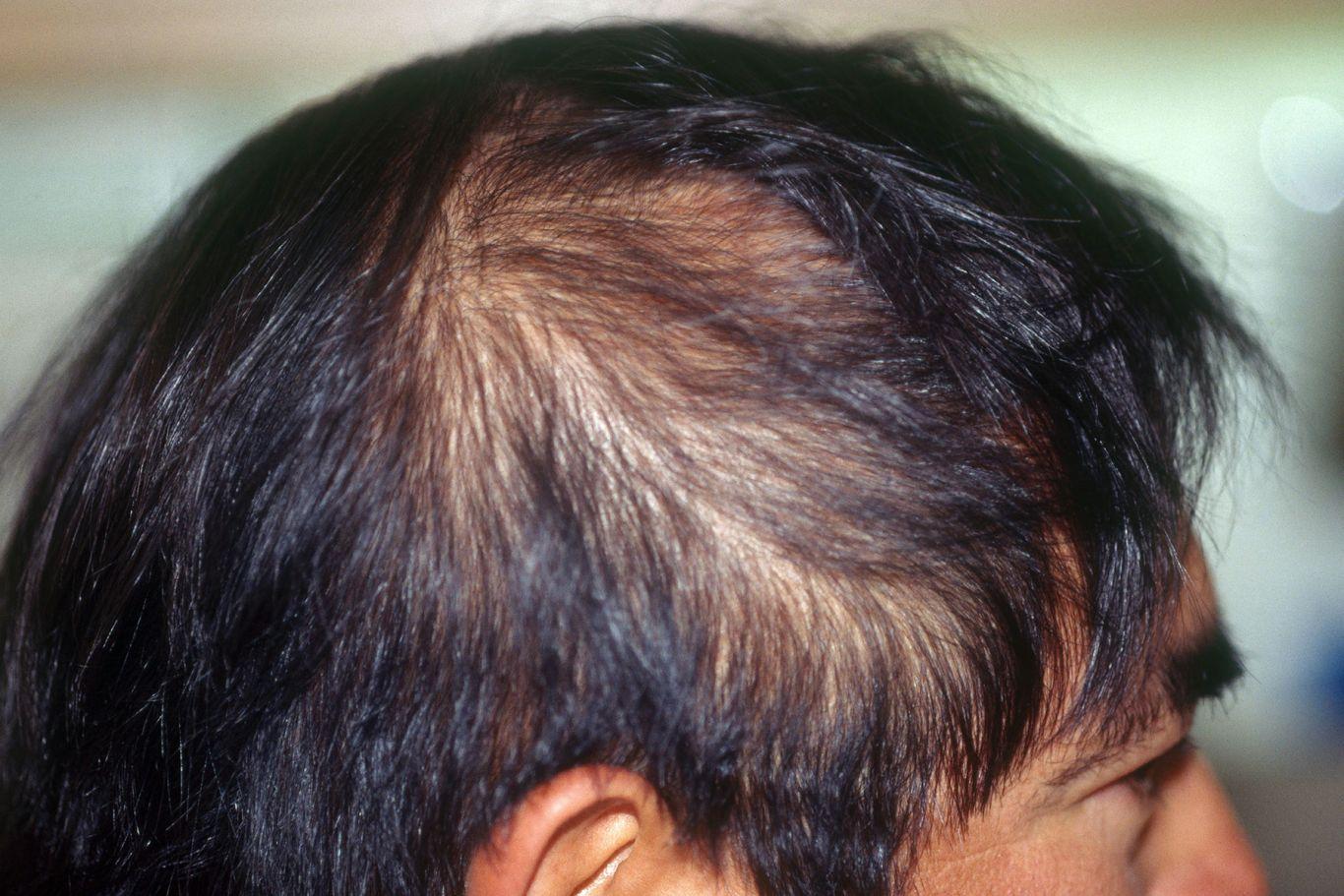 ✅  Nguyên nhân và cách điều trị tóc thưa mỏng