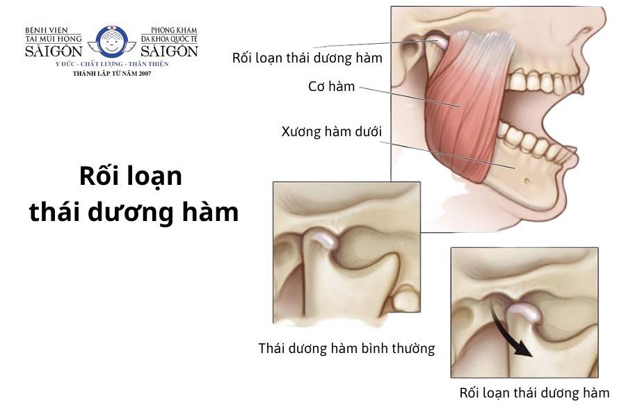 Rối loạn thái dương hàm