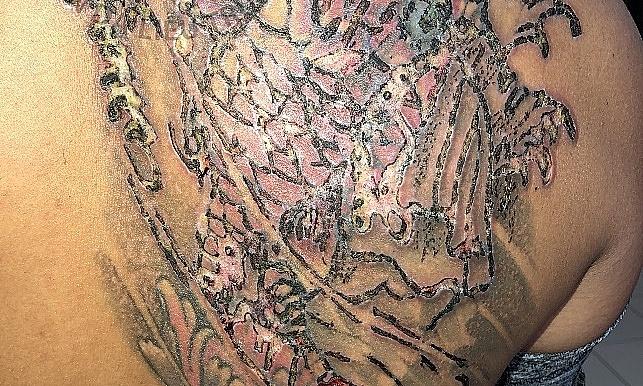 Xăm rồi xoá, thanh niên chằng chịt vết mủ trên vai phải do biến chứng