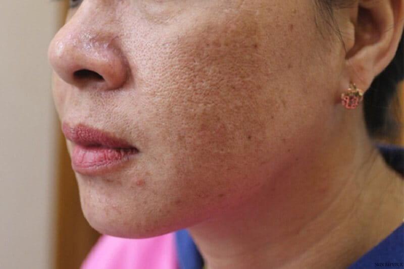 Nám mảng là gì? Dấu hiệu nhận biết, nguyên nhân và cách điều trị hiệu quả nhất