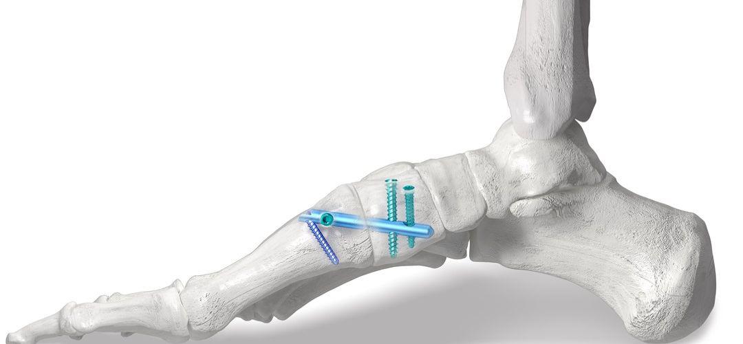 Mổ rút đinh để tháo đinh vít được lắp cố định trong xương sau phẫu thuật chấn thương chỉnh hình