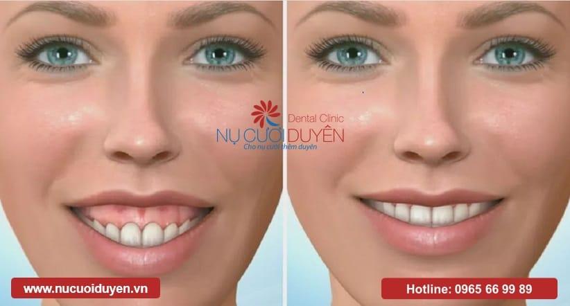 Recreate a gummy smile