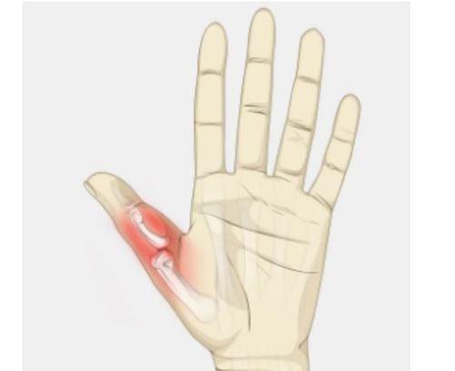 Đau khớp ngón tay cái: Nguyên nhân và phương pháp điều trị hiệu quả