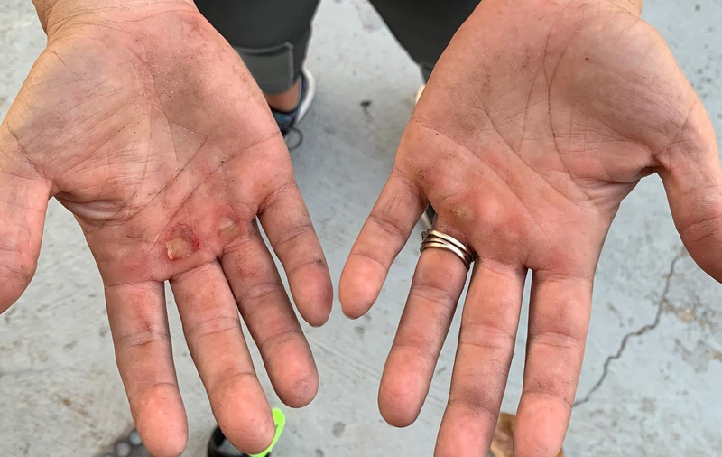 Bật mí cách làm hết vết chai ở ngón tay