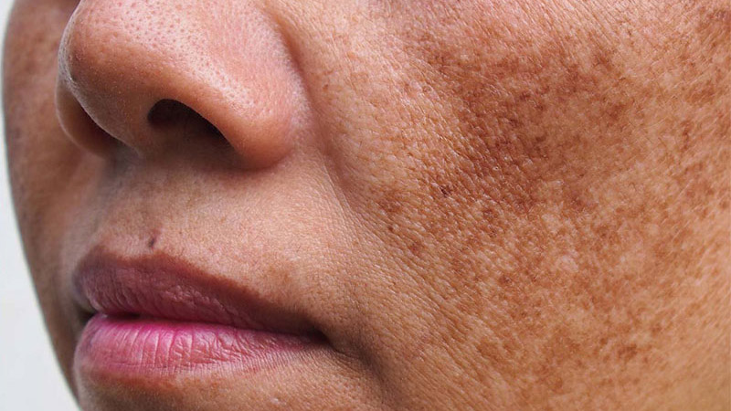 Mách bạn những cách trị nám hiệu quả nhất hiện nay